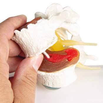 stagesofdiscdegeneration-medstore.ie