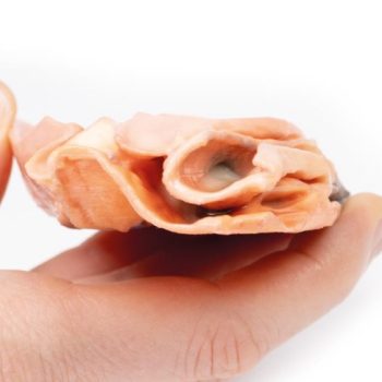 Traumatic Oesophageal-aortic fistula"