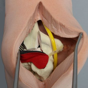 On the Way a New Range of Education: Elbow with Nerve, Tendon, and Four-Part Humeral Fracture, Encased