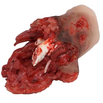 Right Amputation Stump