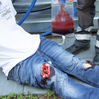 Wound moulage wound packing"