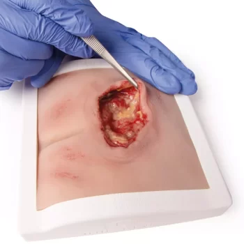 Wound moulage sacral decubitus, cleaned including stand