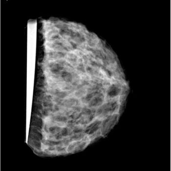 Breast Phantom for Mammography and Breast Tomosynthesis