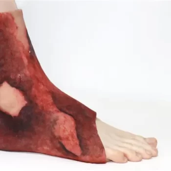 The Burns Ankle Sleeve