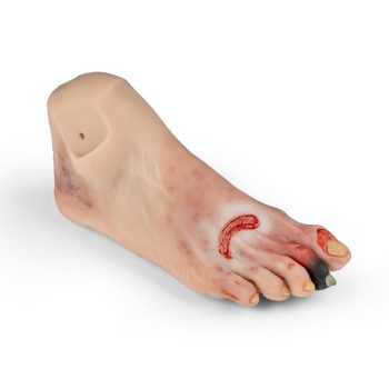 Wound foot with diabetic foot syndrome