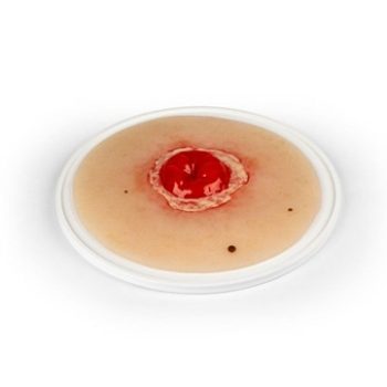 Wound moulage Colostomy inflamed, self-adhesive