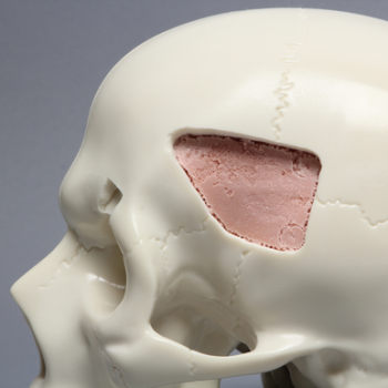 Skull with fracture and Craniotomies