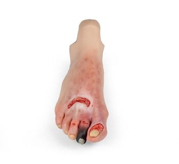 Wound foot with diabetic foot syndrome for Nursing Anne