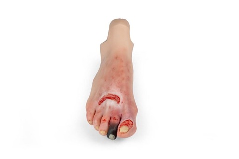 Wound foot with diabetic foot syndrome for Nursing Anne