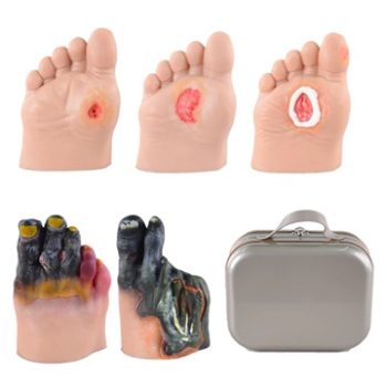 Five Stages of Diabetic Foot Ulcer Model Set