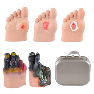 Five Stages of Diabetic Foot Ulcer Model Set